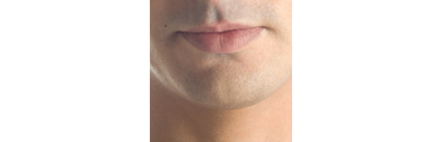 Rash around Mouth—Pictures, Causes, & Treatment | Healdove